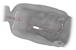 TransCarotidArtery Revasculartion Procedure