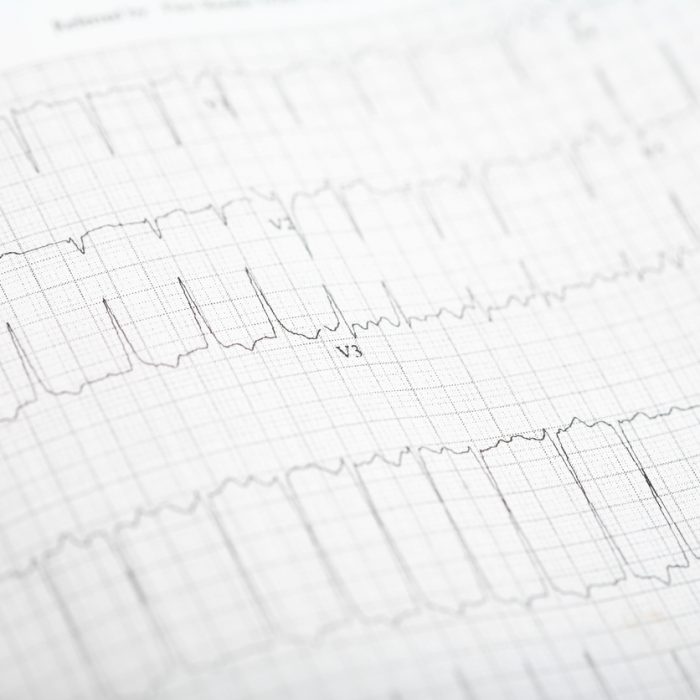 EKG or Electrocardiogram of a patient showing symptoms of Atrial Fibrillation.