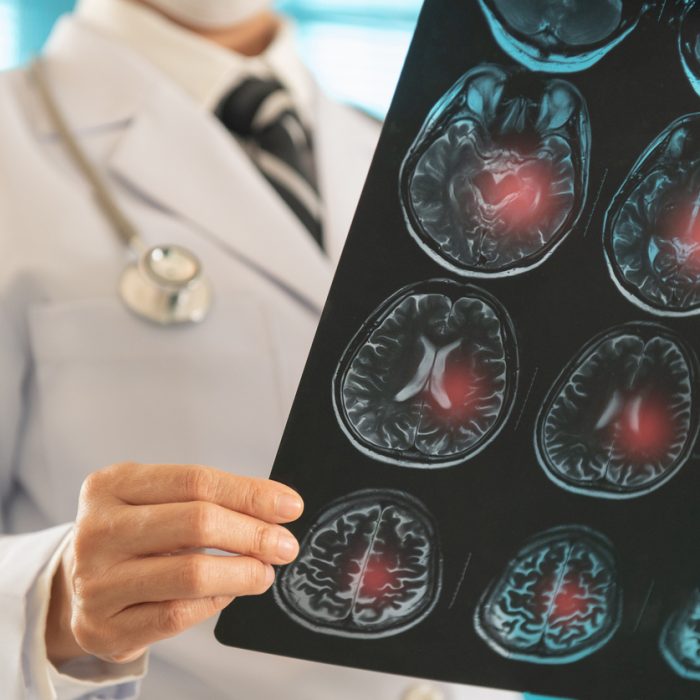 Doctor radiology looking stroke brain x-ray image for diagnose ischemic stroke or cerebrovascular disease at hospital.