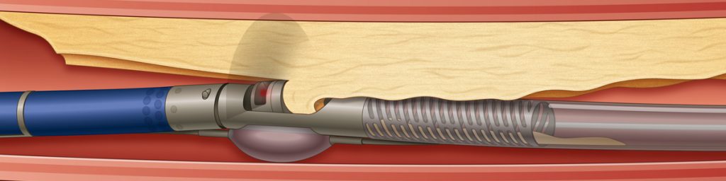 A catheter with a sharp blade on the end to remove plaque from a blood vessel.