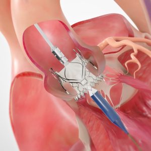 Trilogy™ Transcatheter Heart Valve System for Aortic Valve Regurgitation